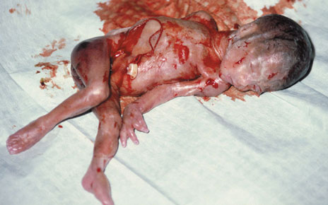 Аборт фото. Abortion photo